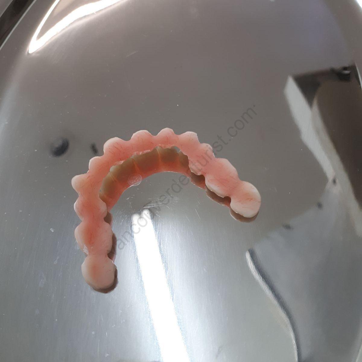 Denture Relines and Rebases Shmitsman's Denture Clinic